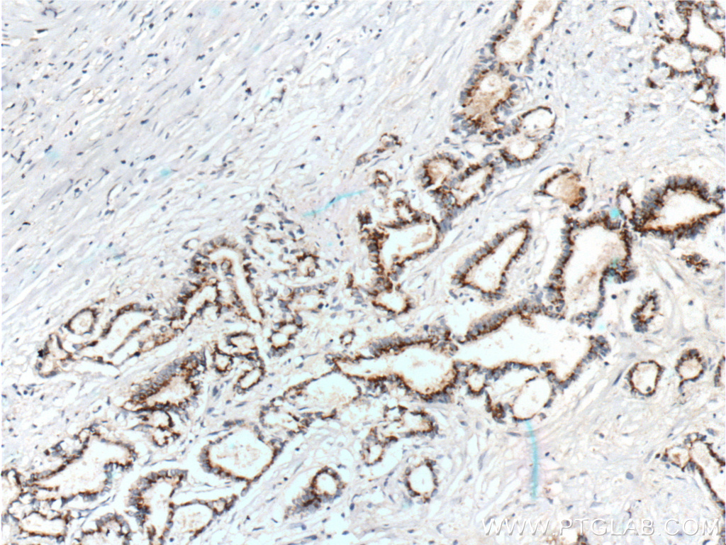 IHC staining of human pancreas cancer using 60269-1-Ig