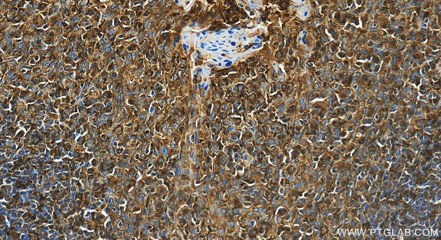IHC staining of human tonsillitis using 84391-4-RR
