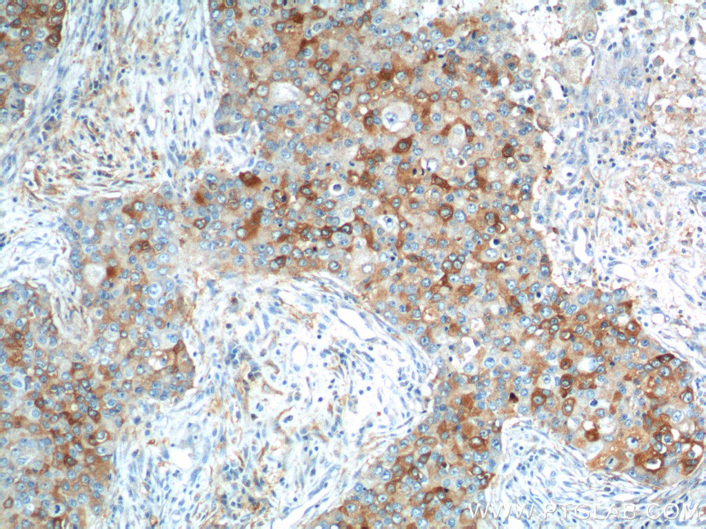 IHC staining of human breast cancer using 11059-1-AP