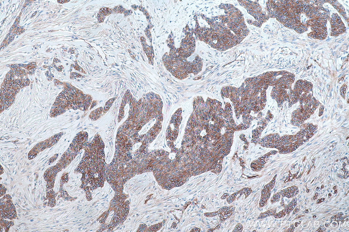 IHC staining of human skin cancer using 66148-1-Ig