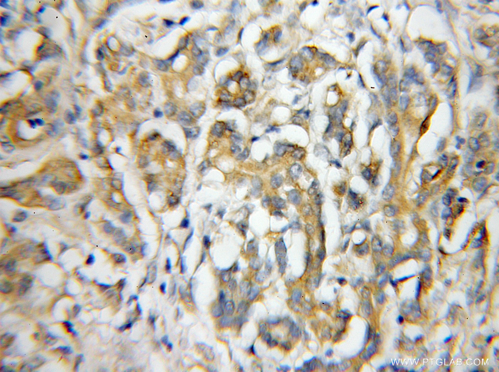 IHC staining of human pancreas cancer using 11984-1-AP