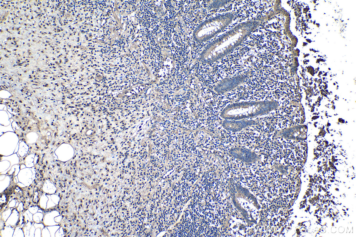 IHC staining of human appendicitis using 16765-1-AP