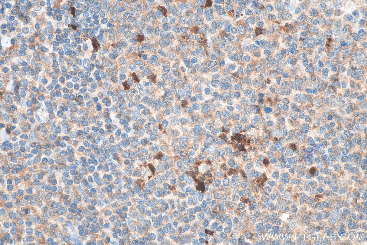 IHC staining of human tonsillitis using 16806-1-AP