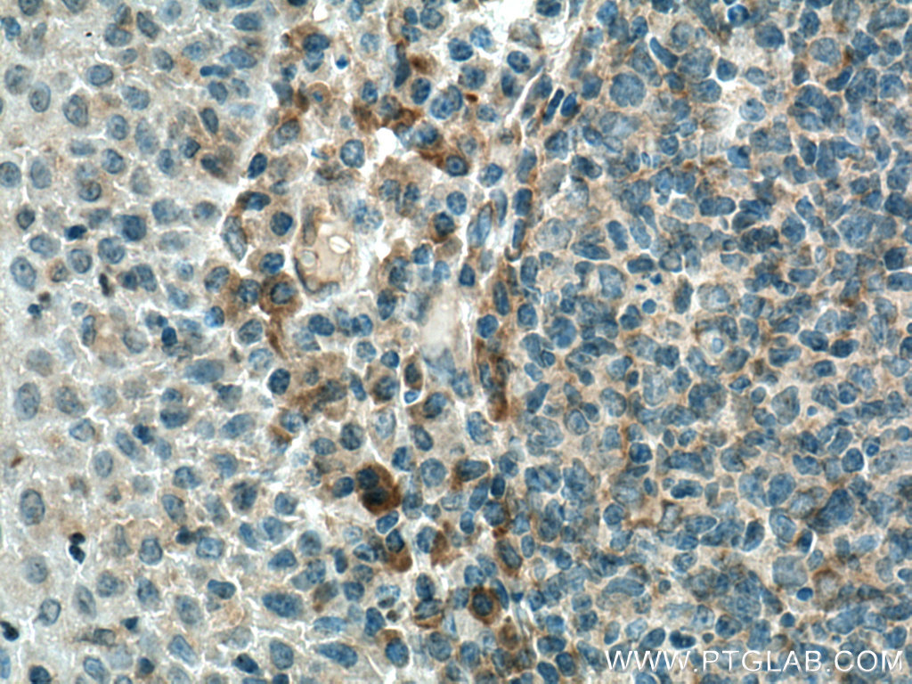 IHC staining of human tonsillitis using 11863-1-AP