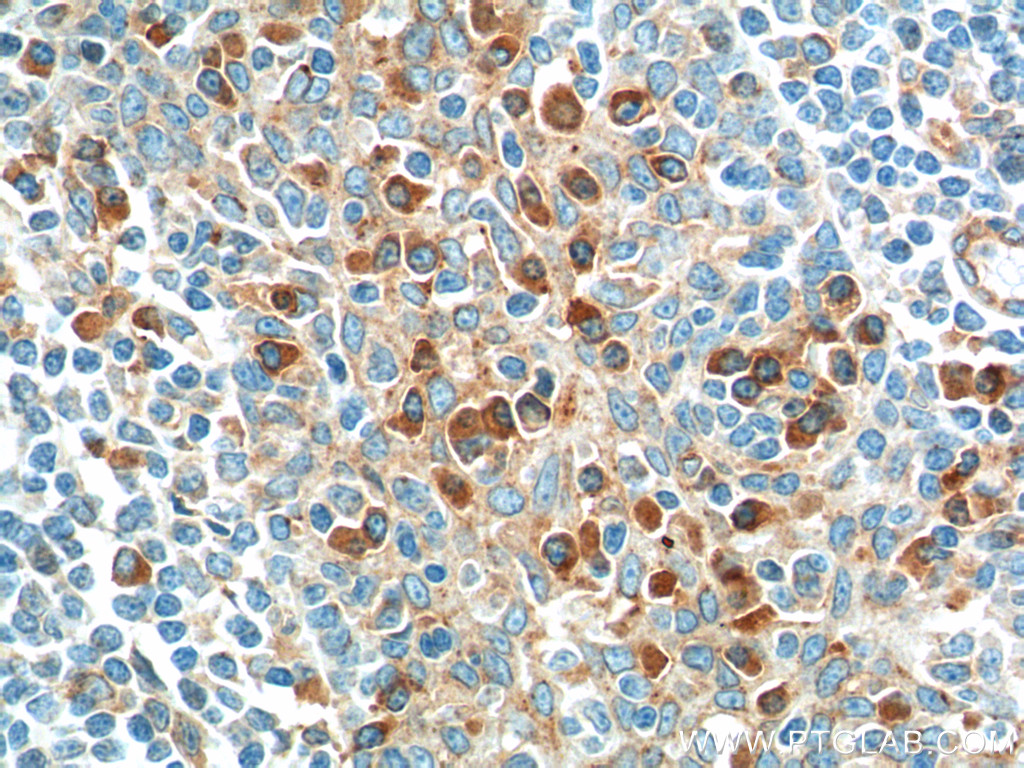 IHC staining of human tonsillitis using 60306-1-Ig