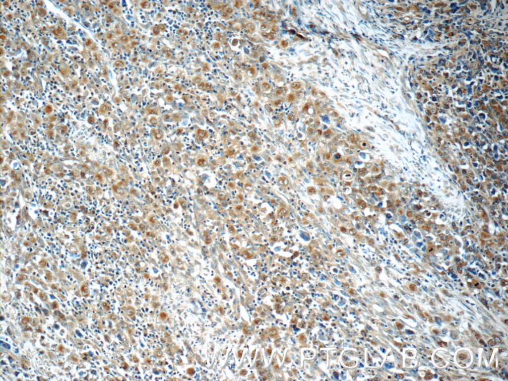 IHC staining of human lymphoma using 10533-1-AP