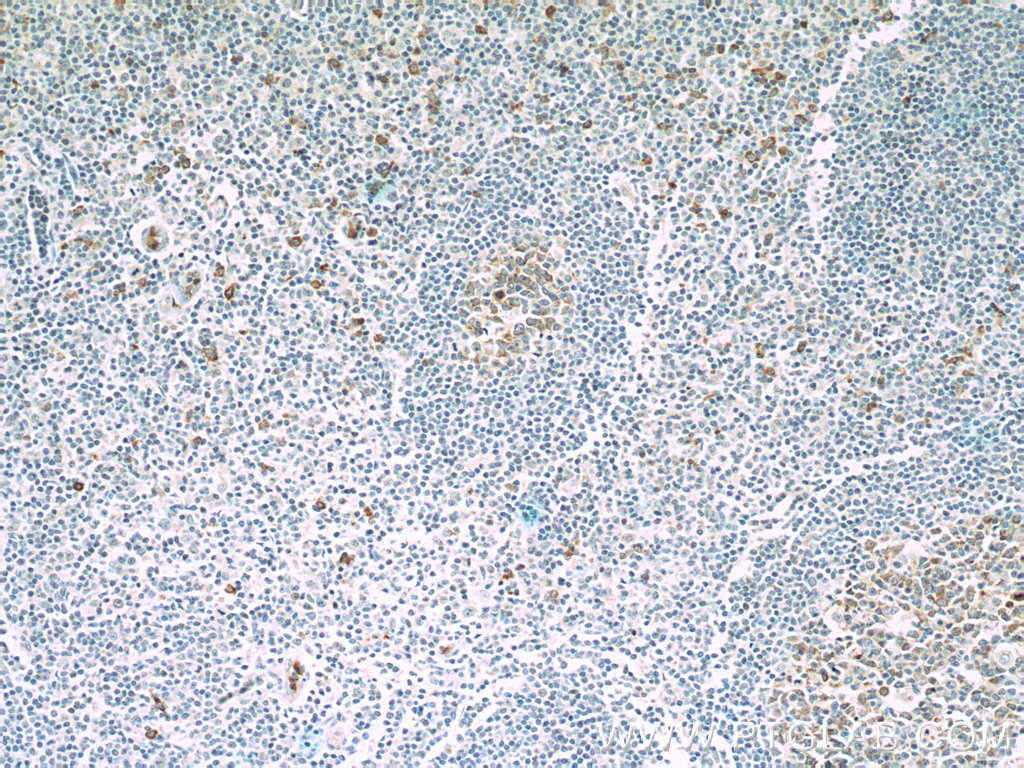 IHC staining of human tonsillitis using 66319-1-Ig