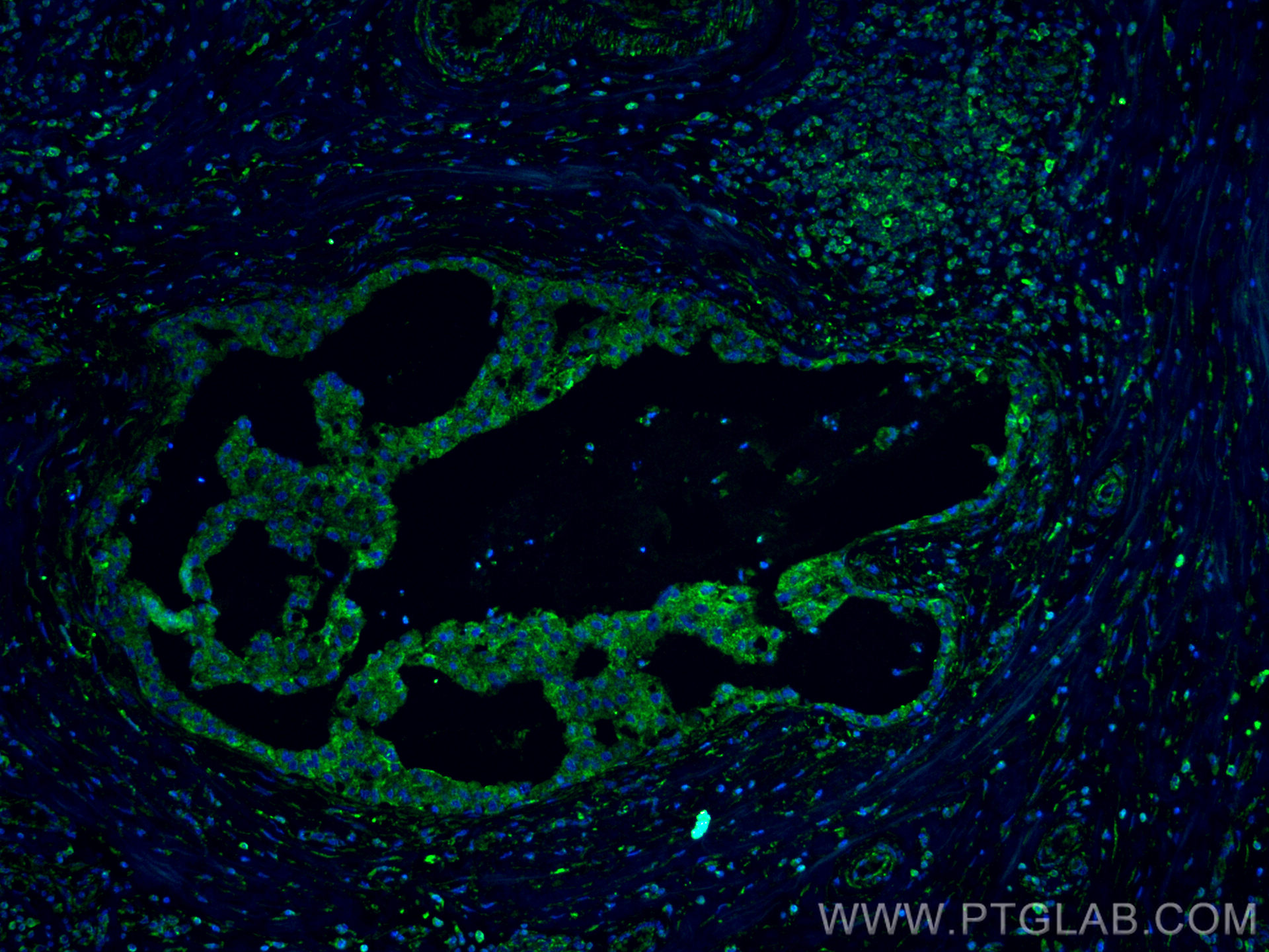 IF Staining of human breast cancer using 66190-1-Ig