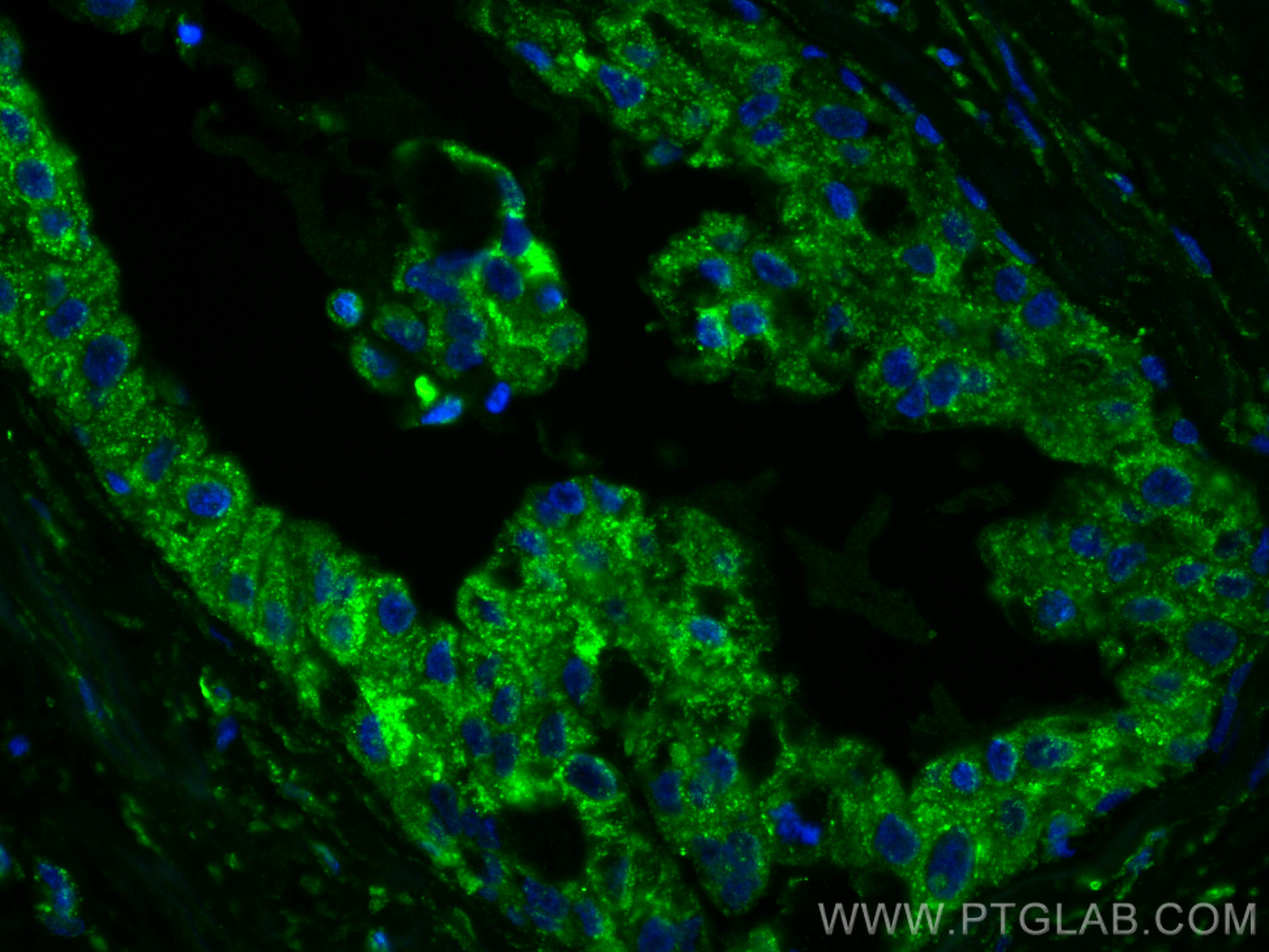 IF Staining of human breast cancer using 66190-1-Ig (same clone as 66190-1-PBS)