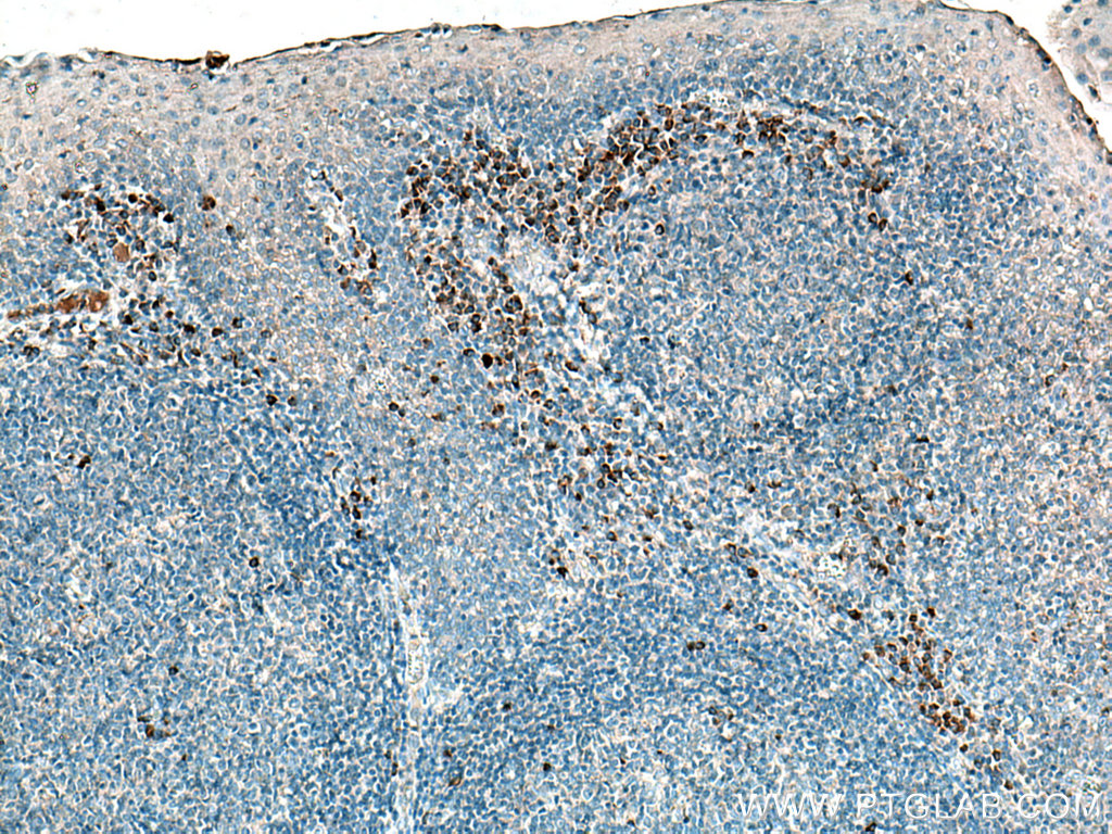 IHC staining of human tonsillitis using 27163-1-AP