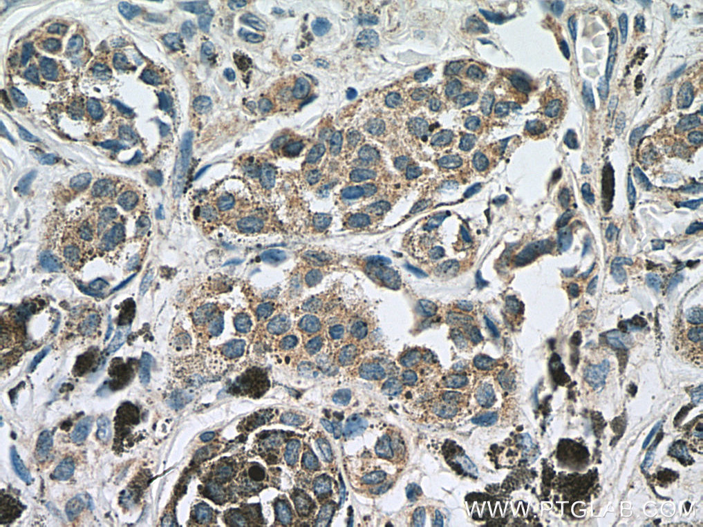 IHC staining of human malignant melanoma using 12064-1-AP