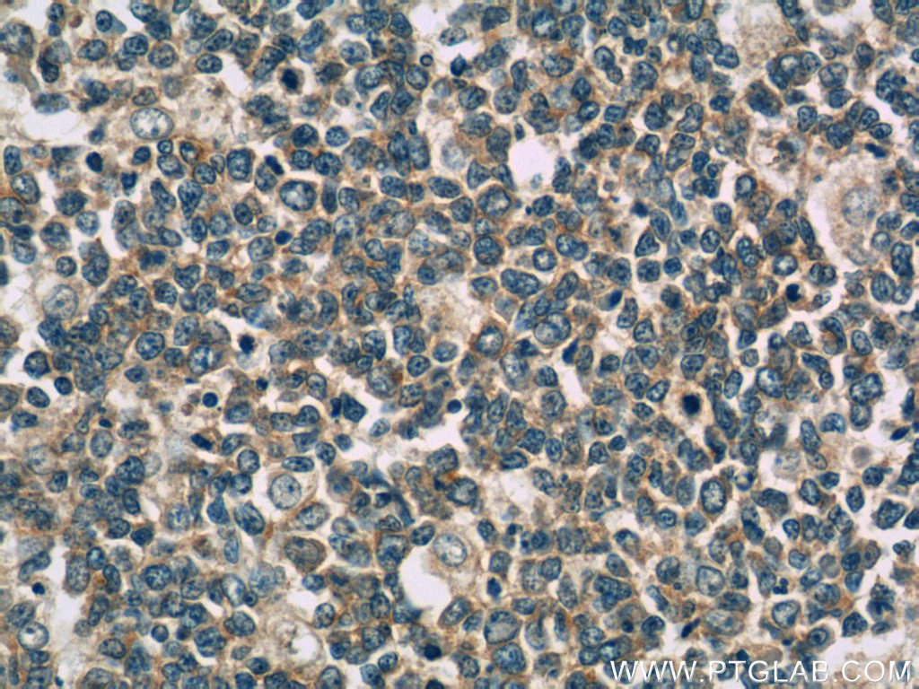 IHC staining of human tonsillitis using 60270-1-Ig