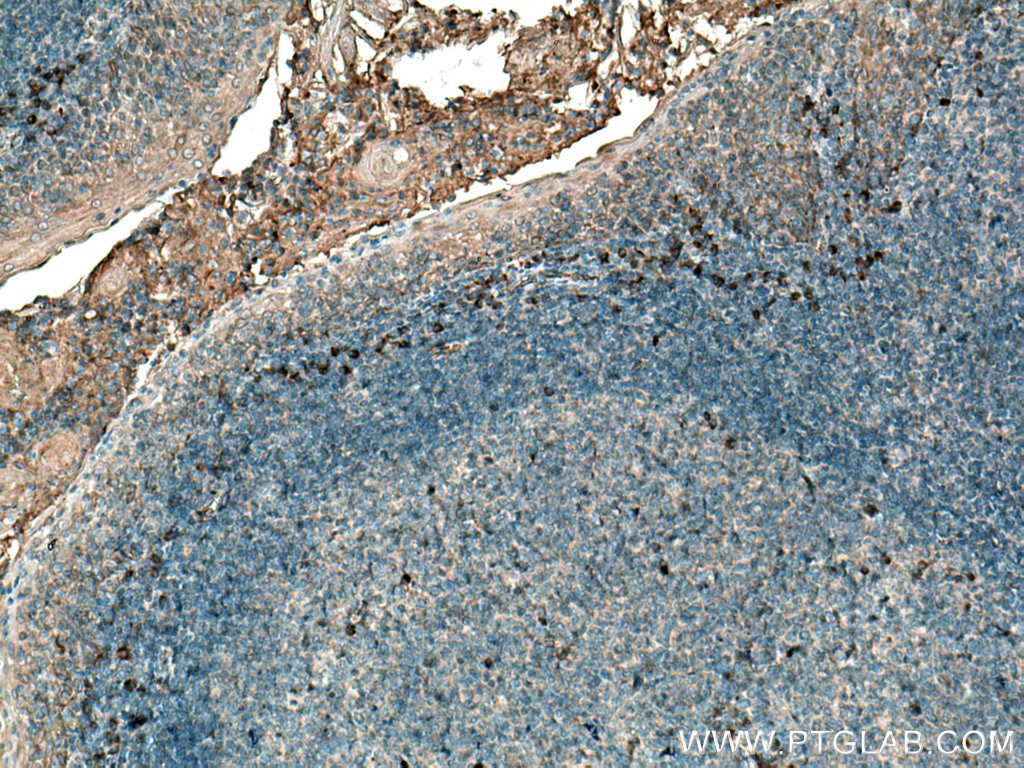 IHC staining of human tonsillitis using 22859-1-AP (same clone as 22859-1-PBS)