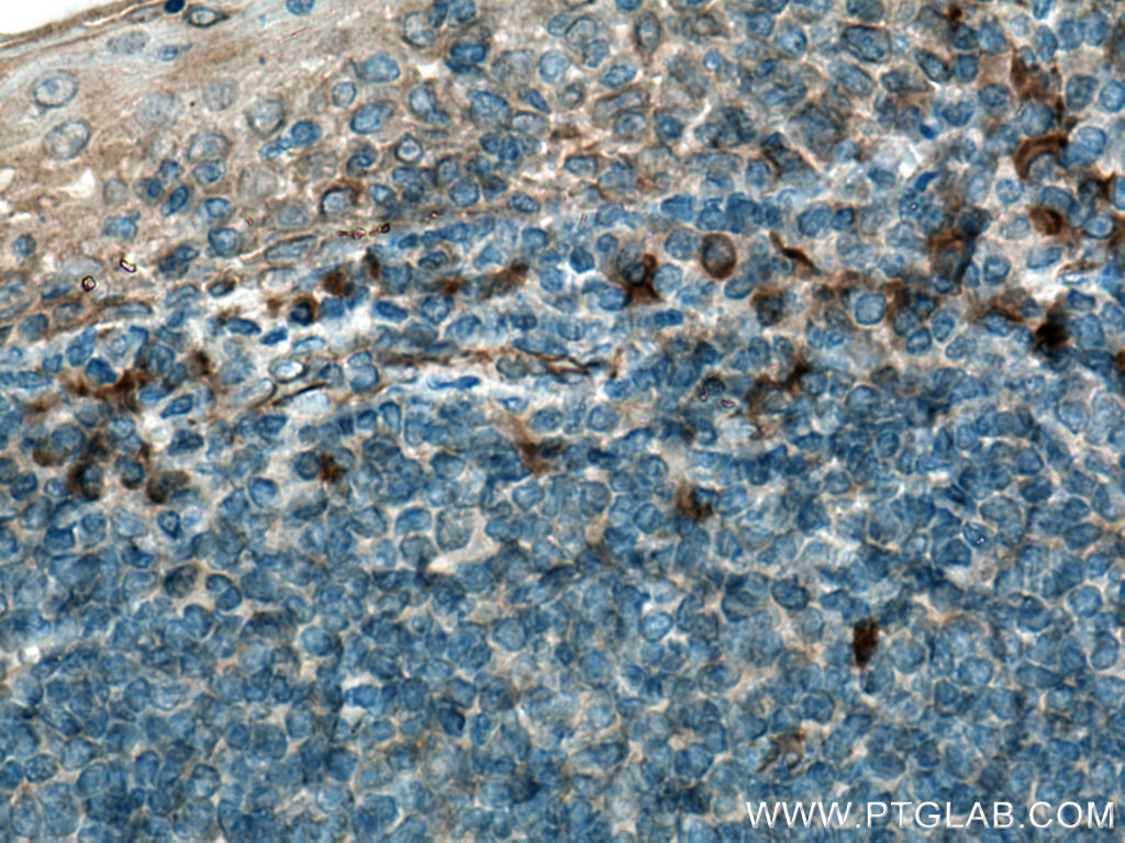 IHC staining of human tonsillitis using 22859-1-AP (same clone as 22859-1-PBS)