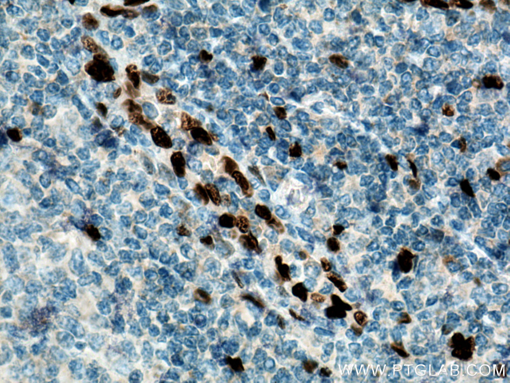 IHC staining of human tonsillitis using 12372-1-AP