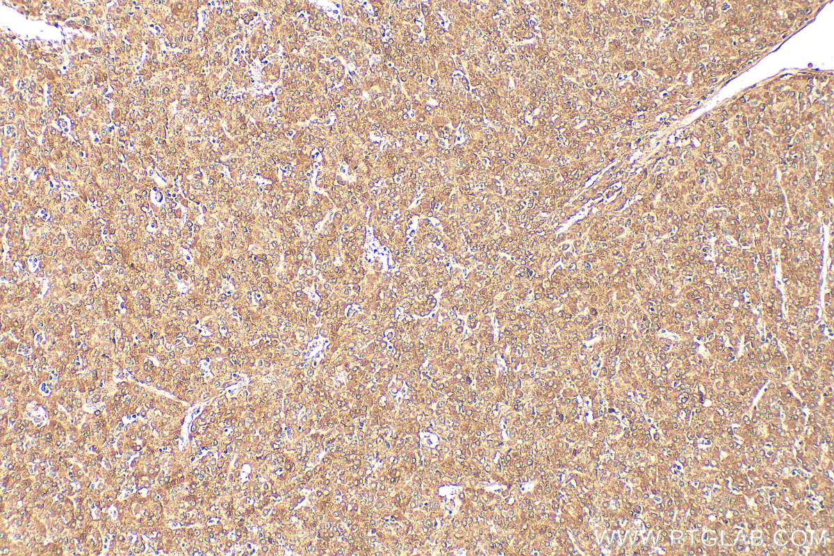 IHC staining of human liver cancer using 12372-1-AP