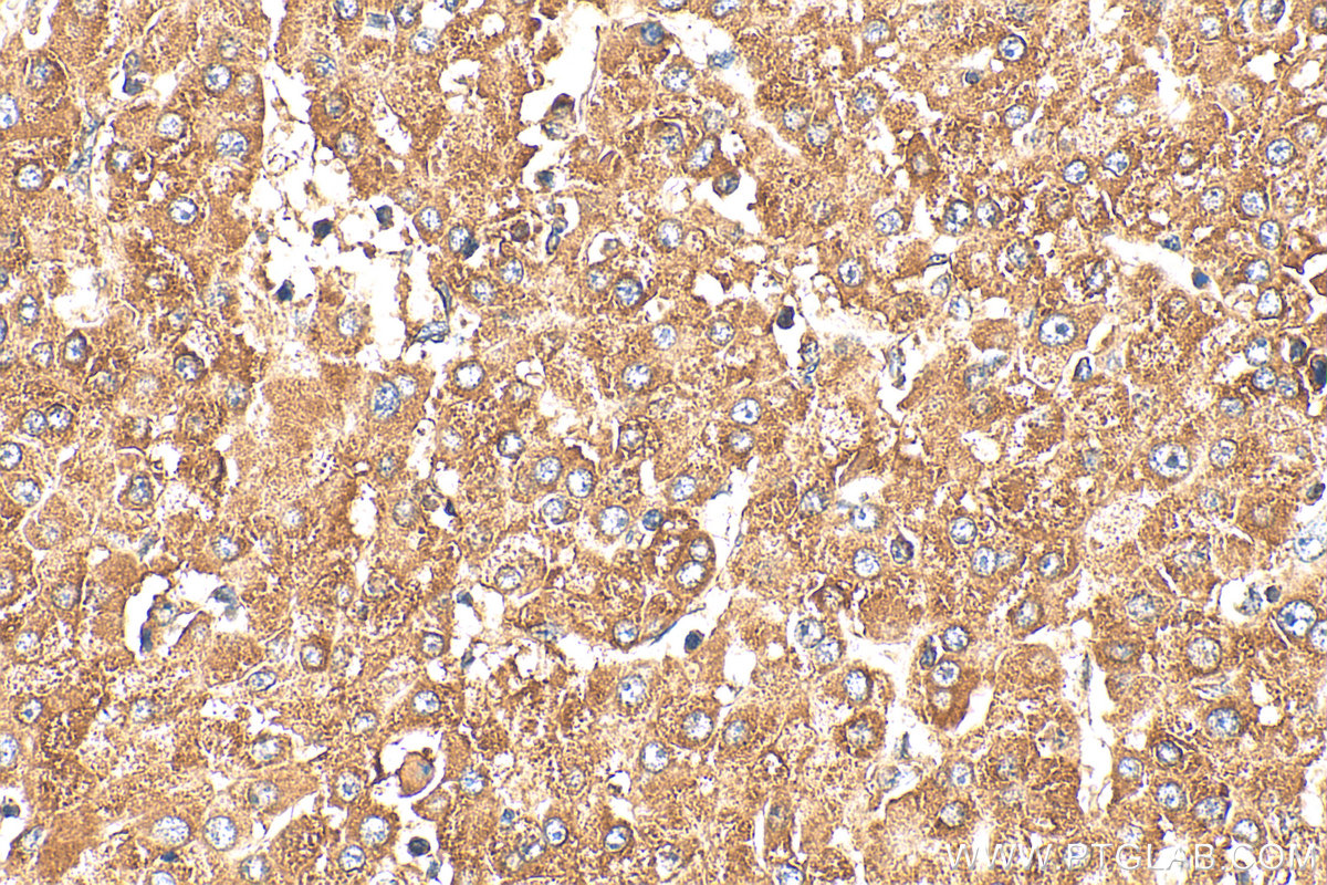 IHC staining of human liver cancer using 12372-1-AP