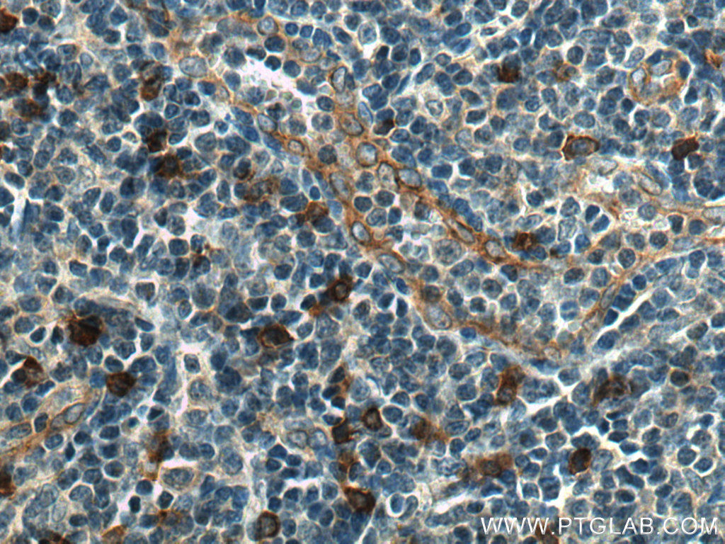 IHC staining of human tonsillitis using 13655-1-AP