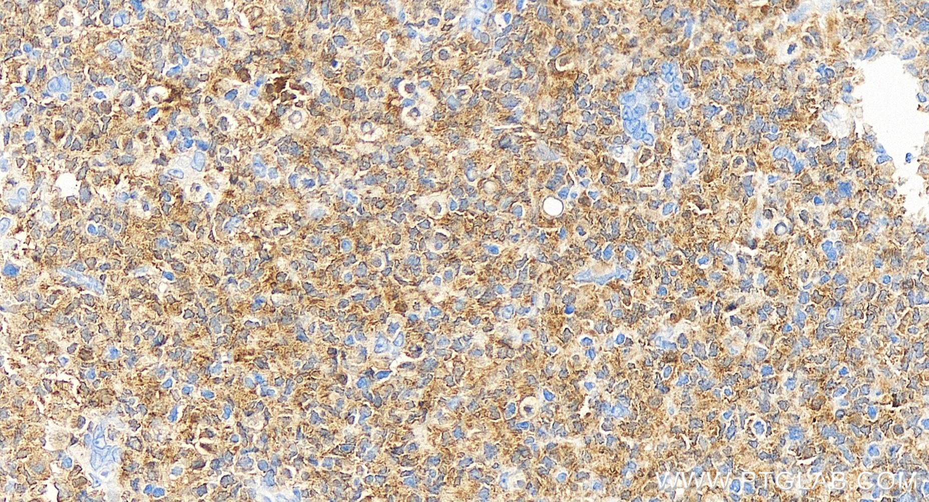 IHC staining of human tonsillitis using 83243-3-RR