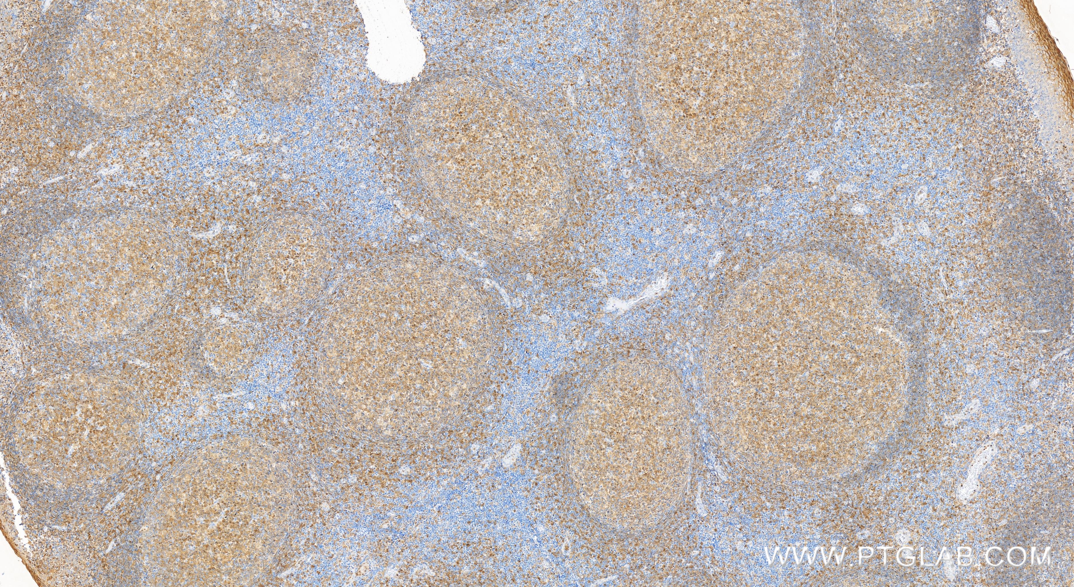 IHC staining of human tonsillitis using 83243-3-RR