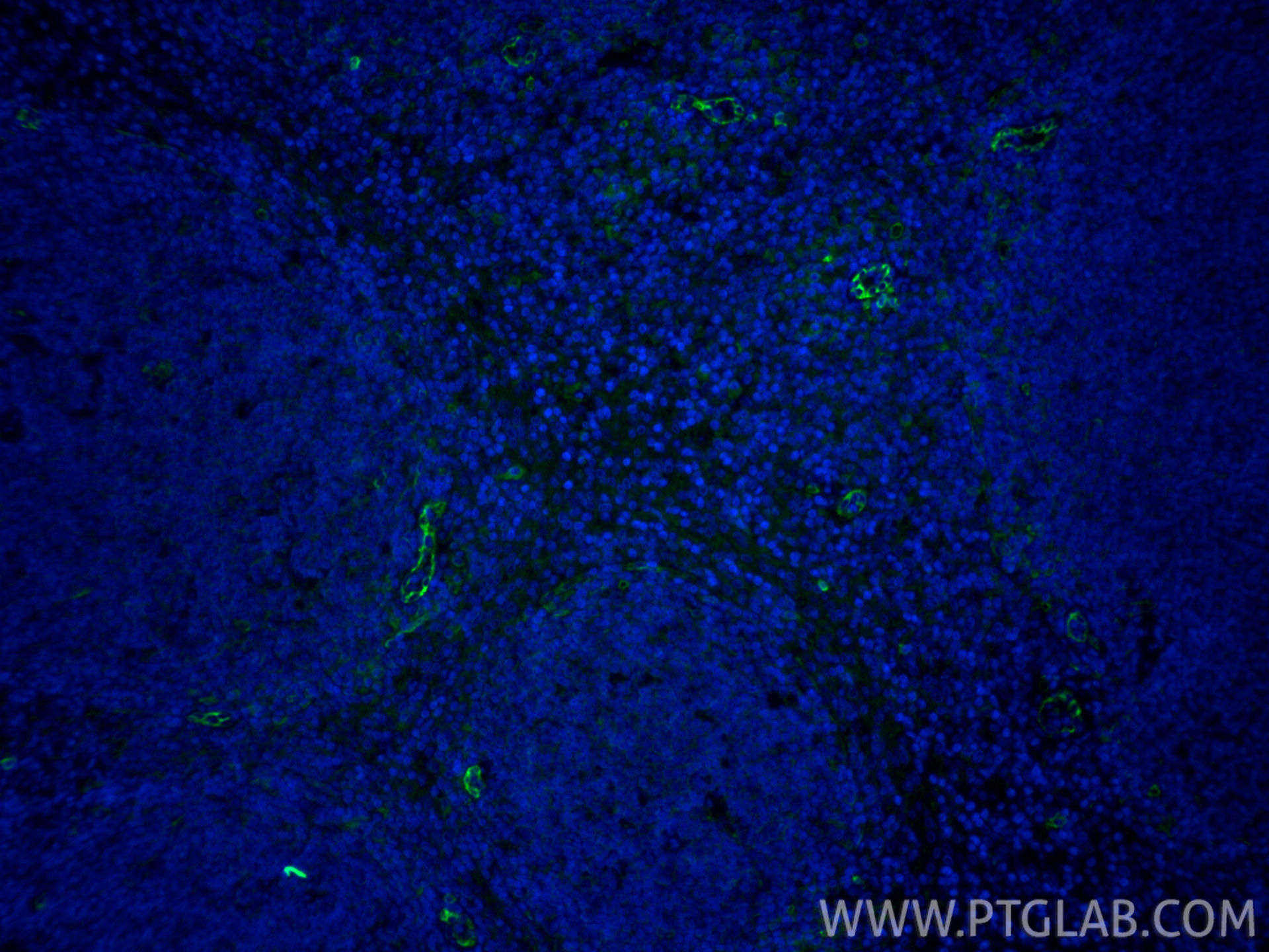 IF Staining of human tonsillitis using 84256-1-RR IF Staining of human tonsillitis using 84256-1-RR