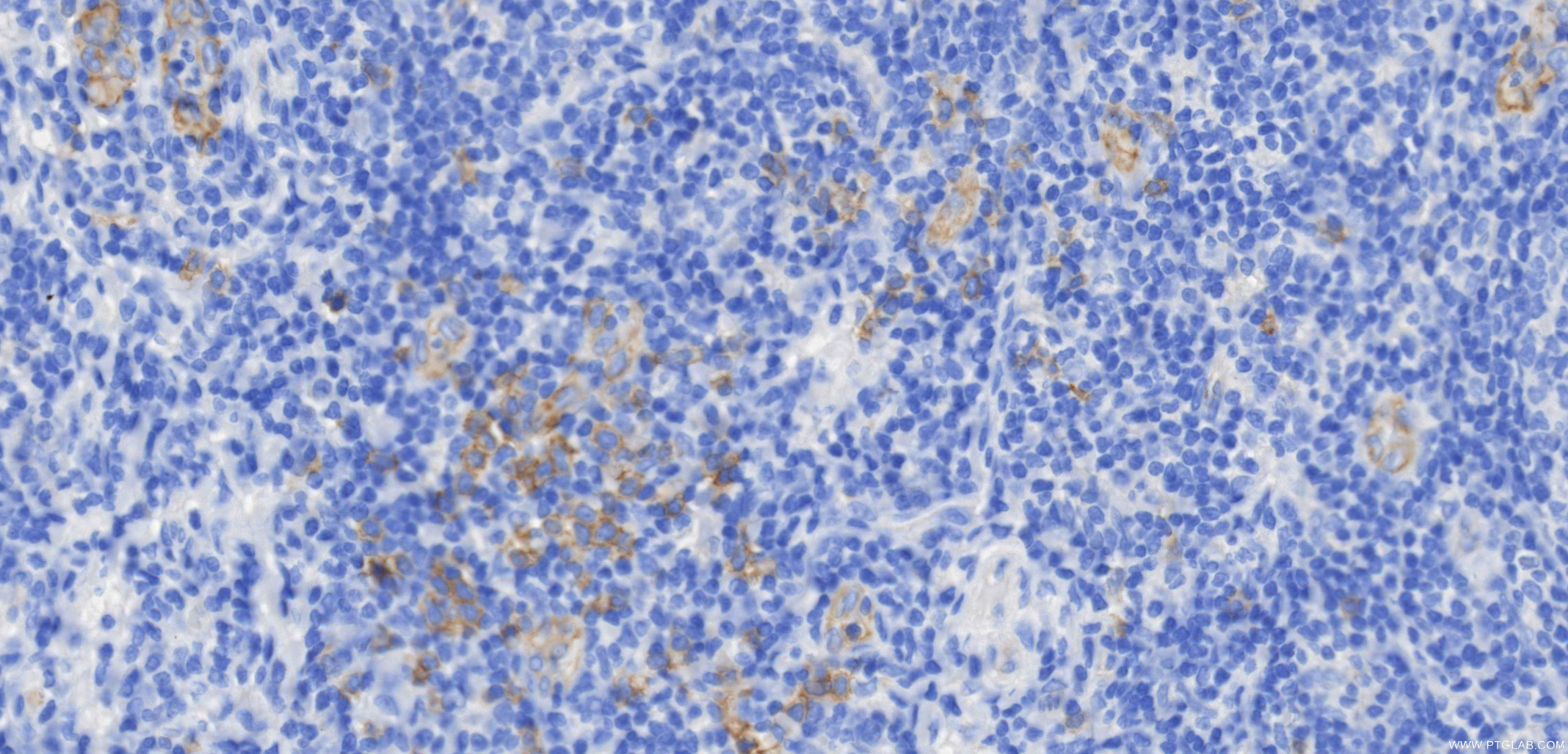 Immunohistochemical analysis of paraffin-embedded human tonsil tissue slide using <a class='green' href='/productredirect?CatalogNo=84256-1-RR' target='_blank'>84256-1-RR</a> (IL3RA/CD123 antibody) at dilution of 1:500 (under 40x lens). Heat mediated antigen retrieval with Tris-EDTA buffer (pH 9.0). This data was developed using the same antibody clone with 84256-1-PBS in a different storage buffer formulation. IHC staining of human tonsil using 84256-1-RR (same clone as 84256-1-PBS)