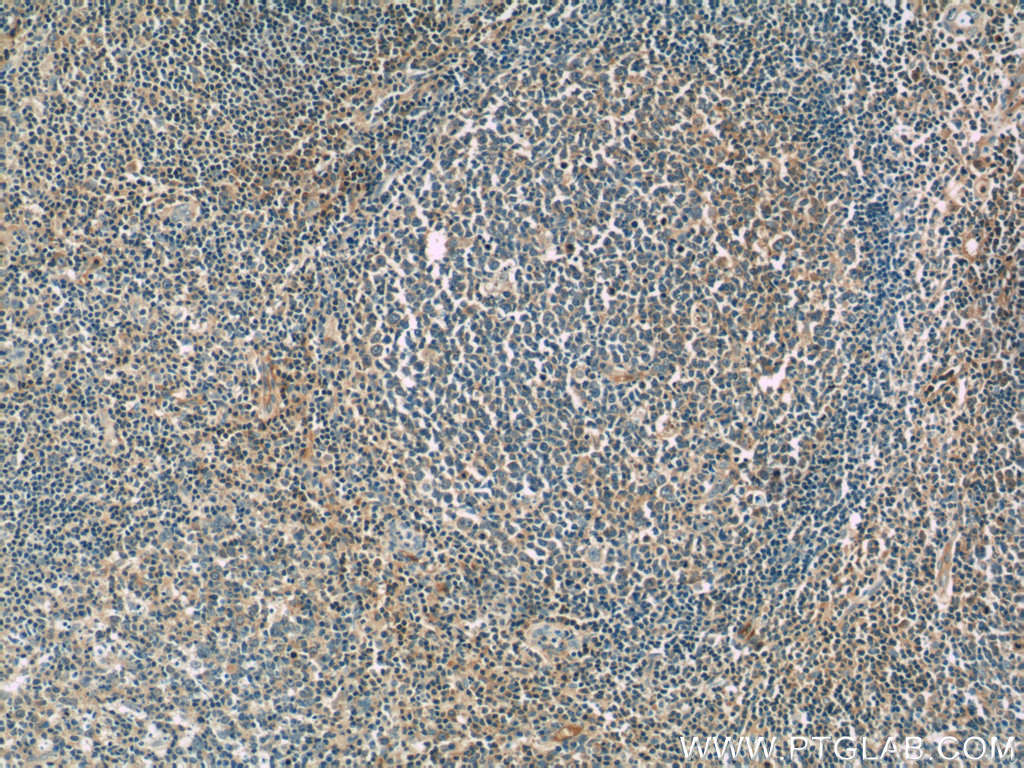 IHC staining of human tonsillitis using 66142-1-Ig