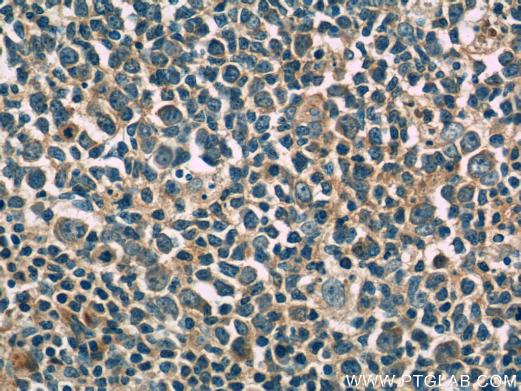 IHC staining of human tonsillitis using 66142-1-Ig