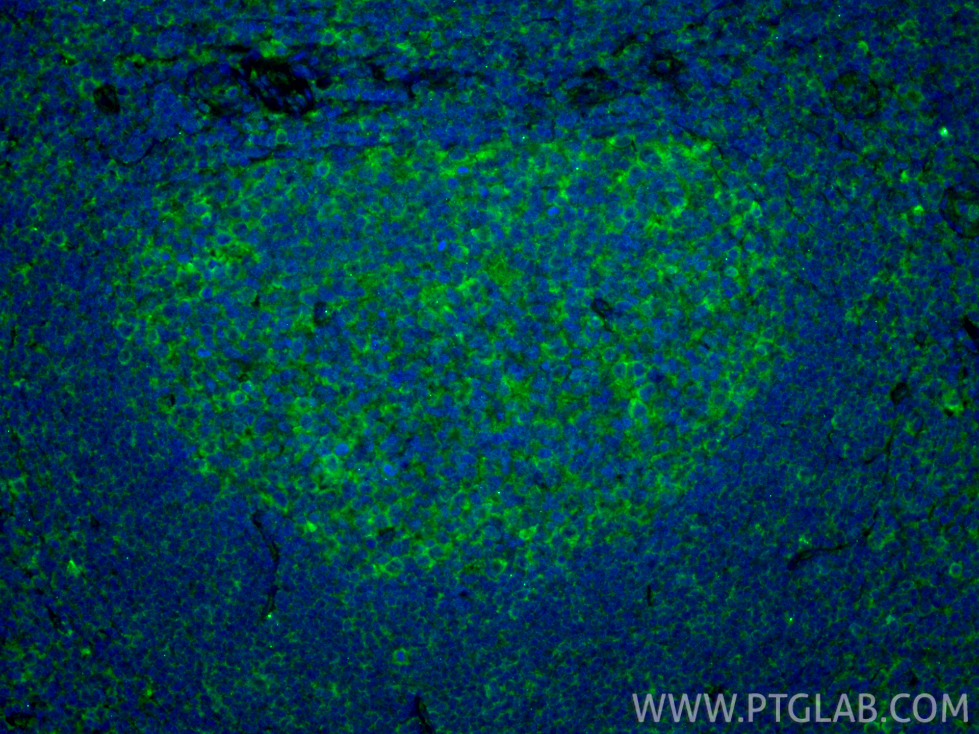 IF Staining of human tonsillitis using 28331-1-AP IF Staining of human tonsillitis using 28331-1-AP