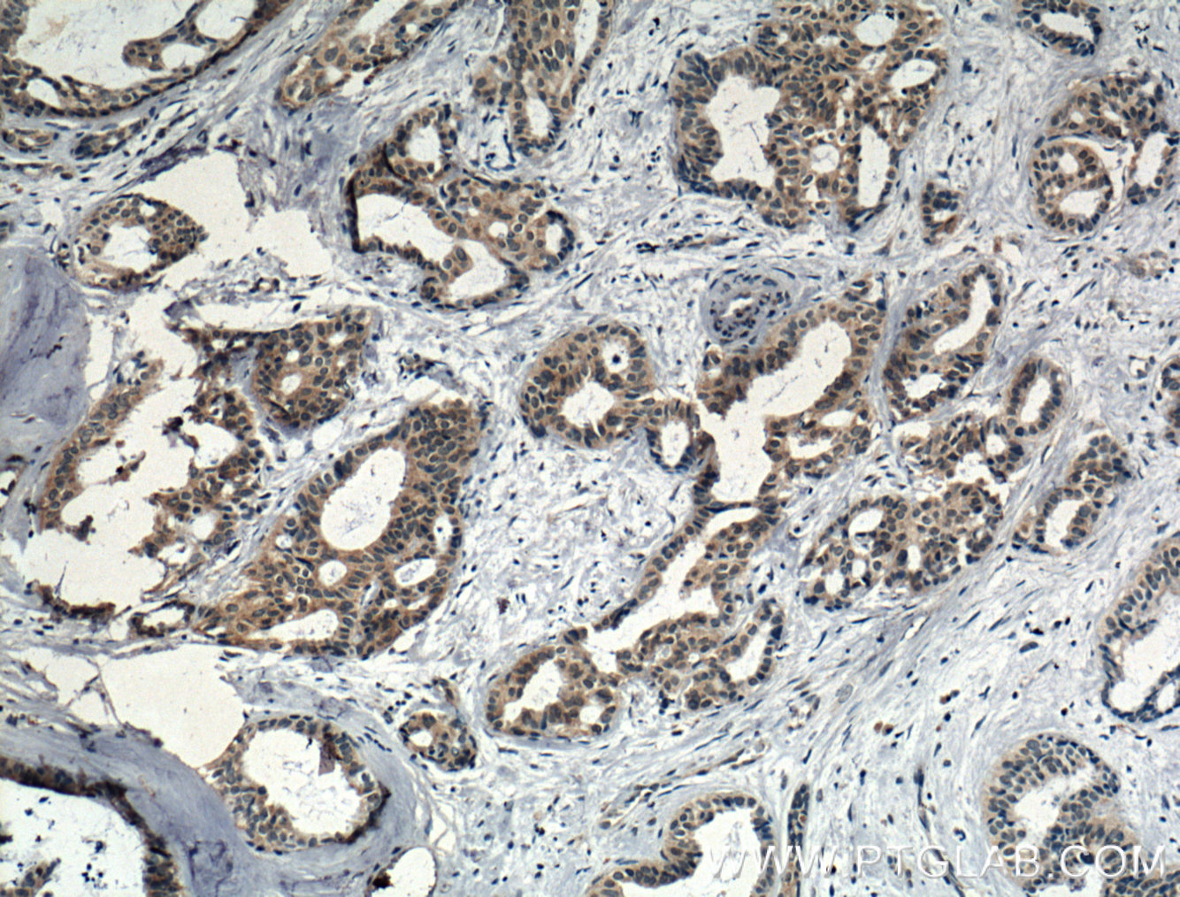 IHC staining of human breast cancer using 26677-1-AP