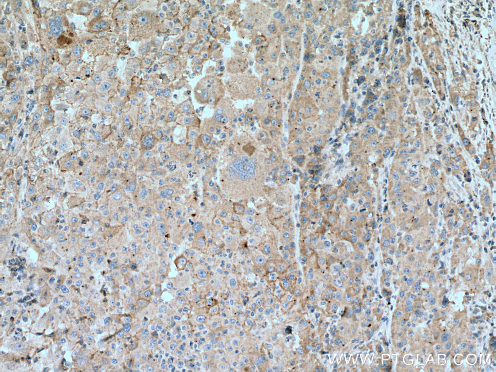 IHC staining of human liver cancer using 66855-1-Ig
