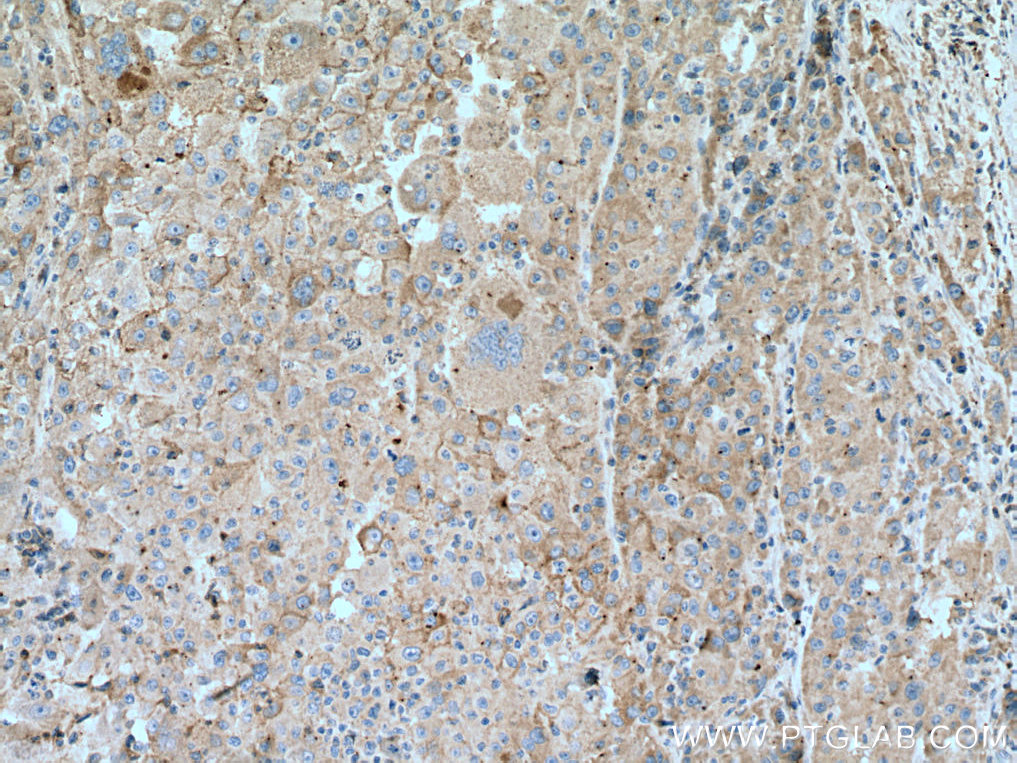IHC staining of human liver cancer using 66855-1-Ig