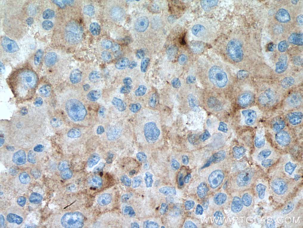 IHC staining of human liver cancer using 66855-1-Ig