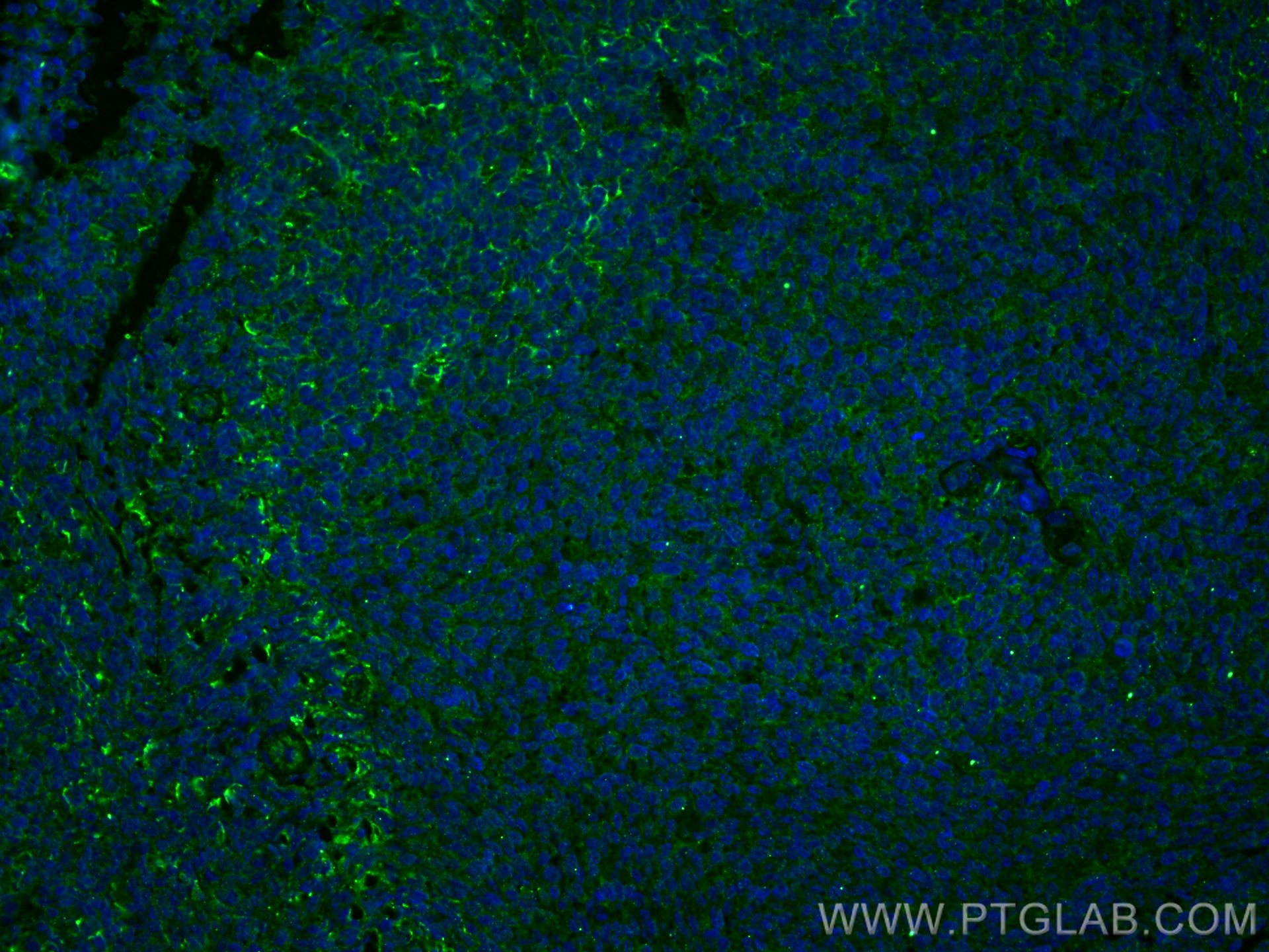 IF Staining of human tonsillitis using 66144-1-Ig