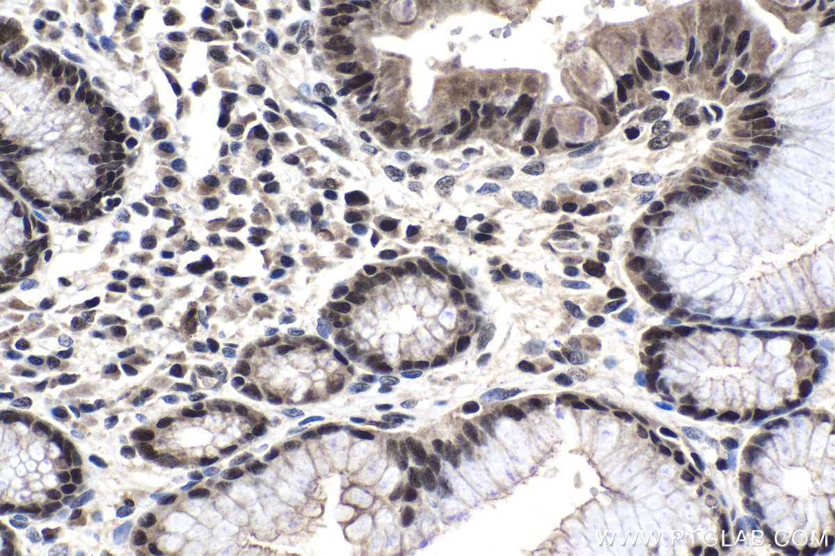 IHC staining of human stomach cancer using 16017-1-AP