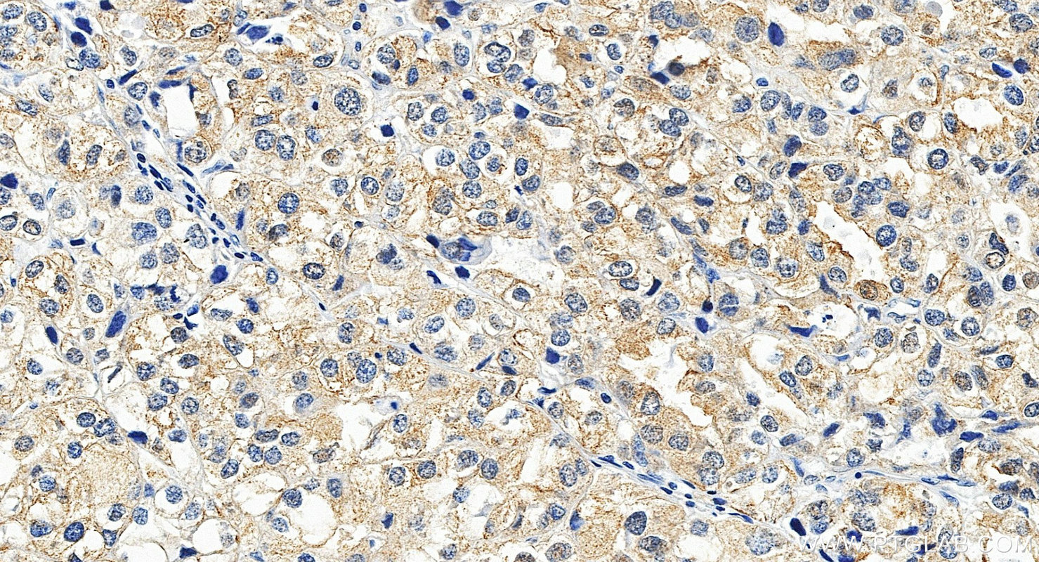 IHC staining of human endometrial cancer using 28422-1-AP IHC staining of human endometrial cancer using 28422-1-AP