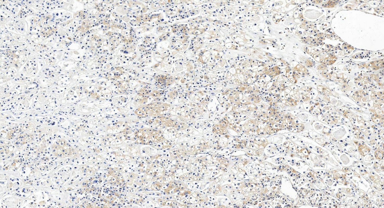 IHC staining of human endometrial cancer using 28422-1-AP IHC staining of human endometrial cancer using 28422-1-AP