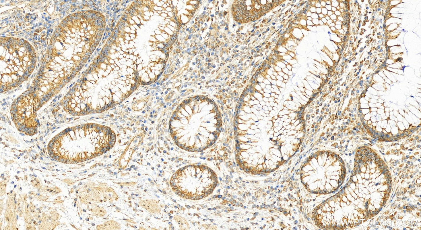 IHC staining of human colon cancer using 11220-1-AP