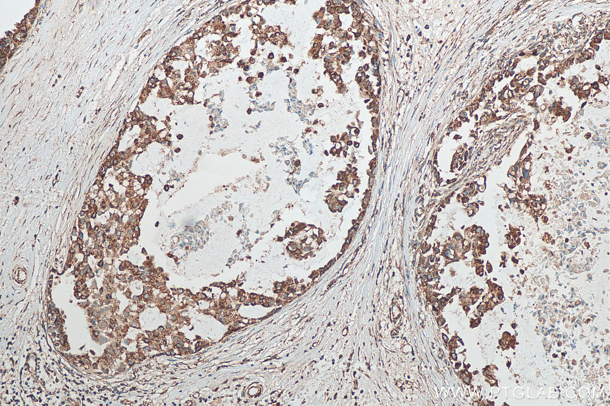 IHC staining of human breast cancer using 10179-1-AP