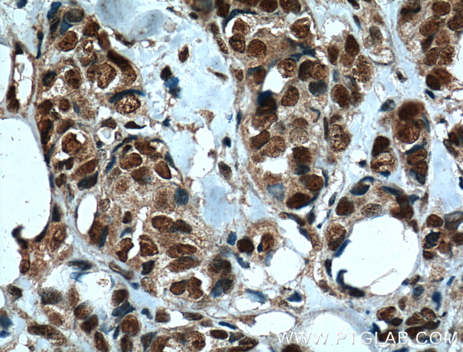 IHC staining of human breast cancer using 66247-1-Ig