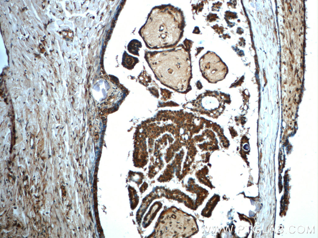 IHC staining of human ovary tumor using 22092-1-AP