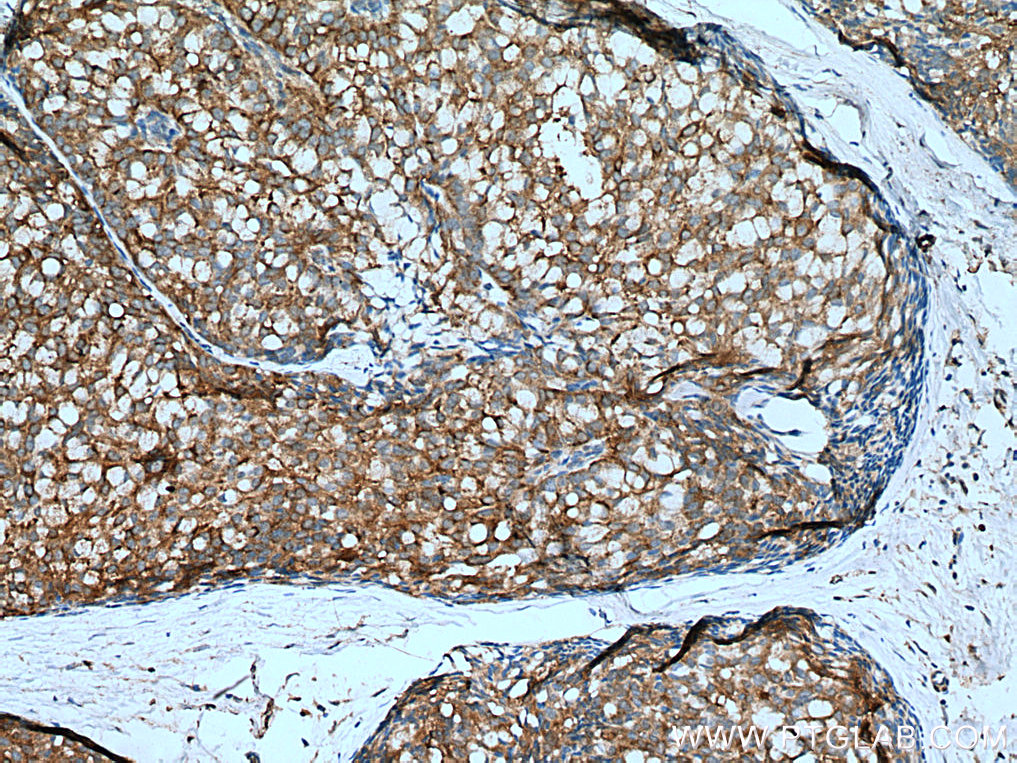 IHC staining of human breast hyperplasia using 67663-1-Ig (same clone as 67663-1-PBS)