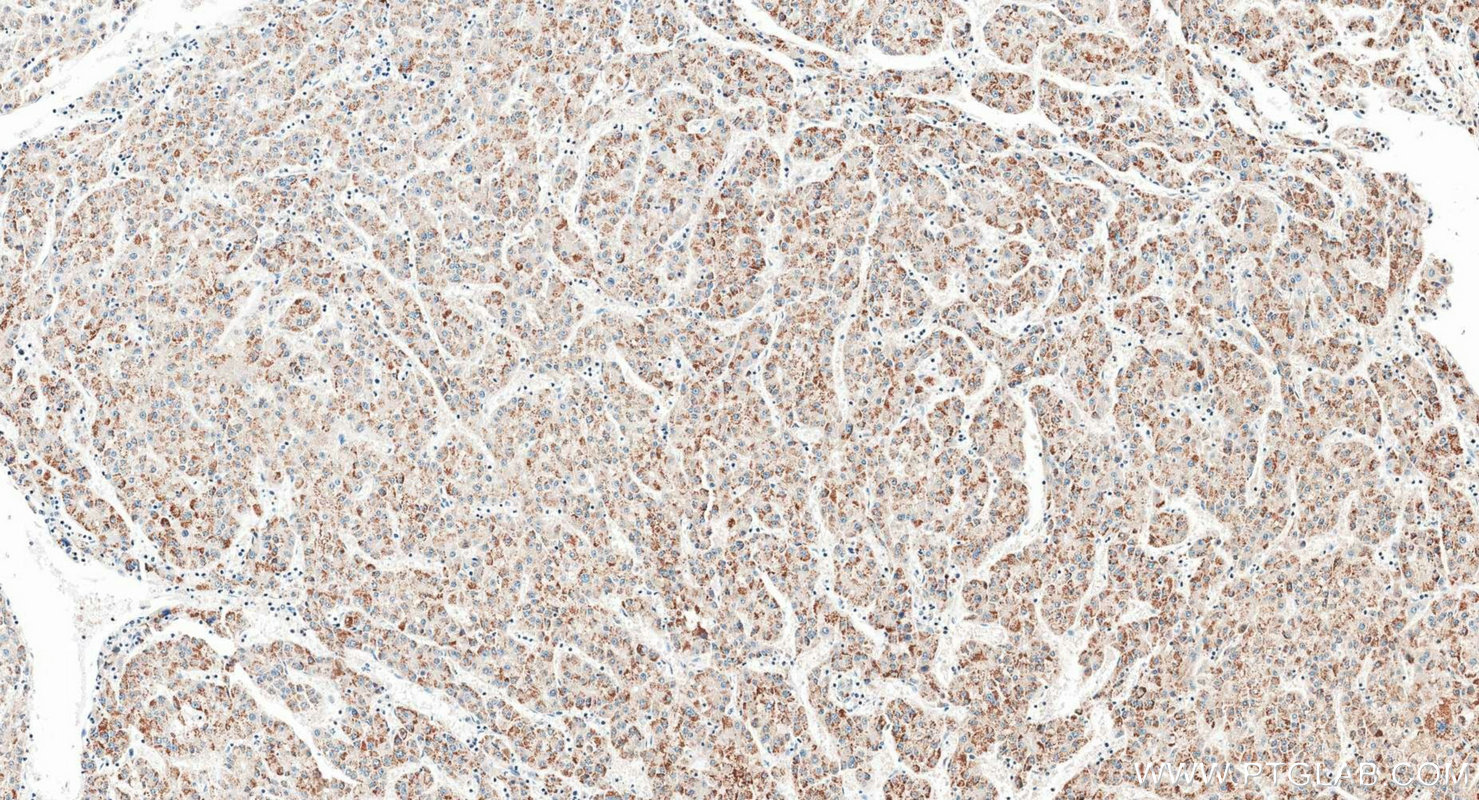 IHC staining of human liver cancer using 21340-1-AP IHC staining of human liver cancer using 21340-1-AP