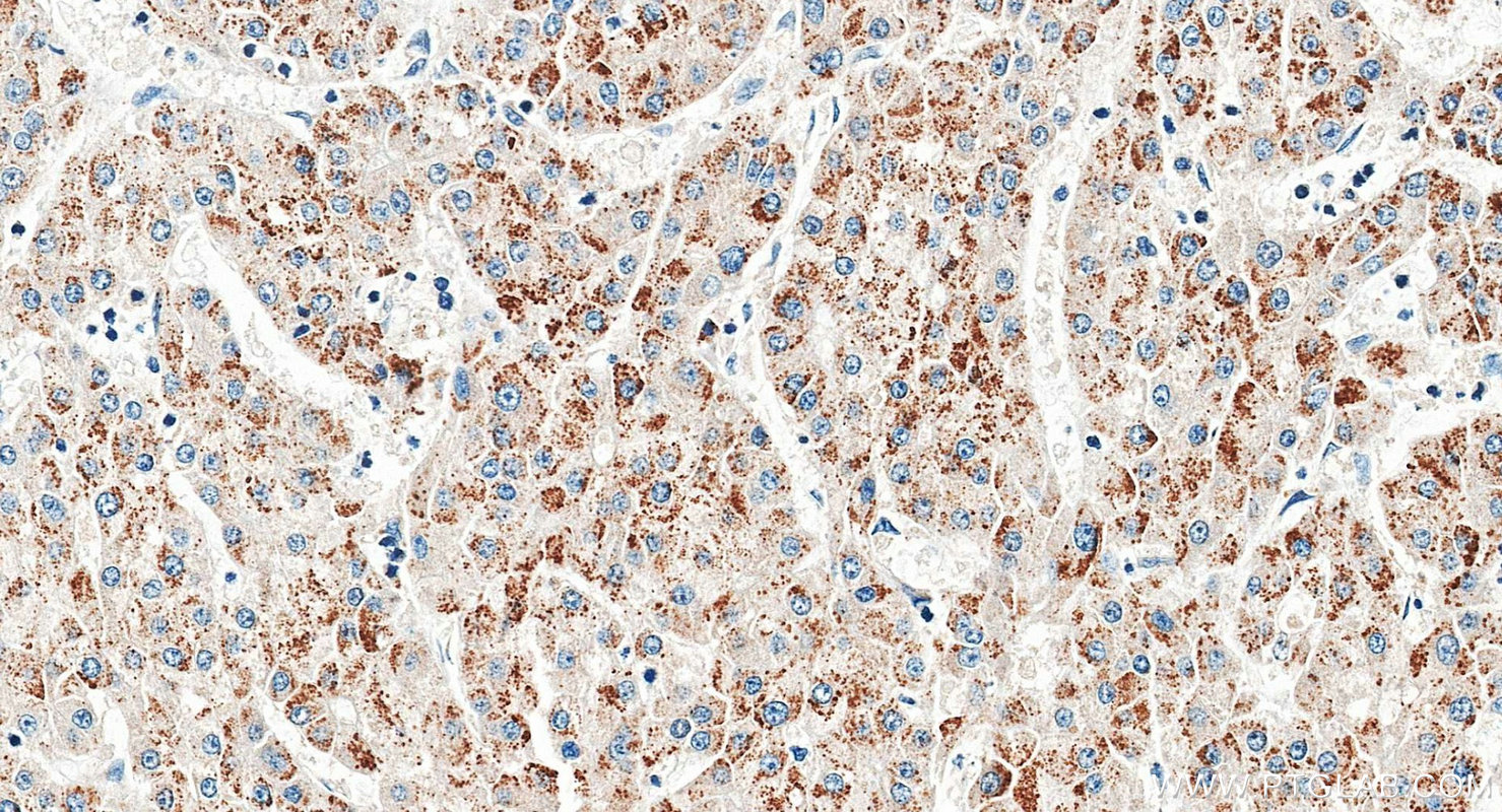 IHC staining of human liver cancer using 21340-1-AP IHC staining of human liver cancer using 21340-1-AP