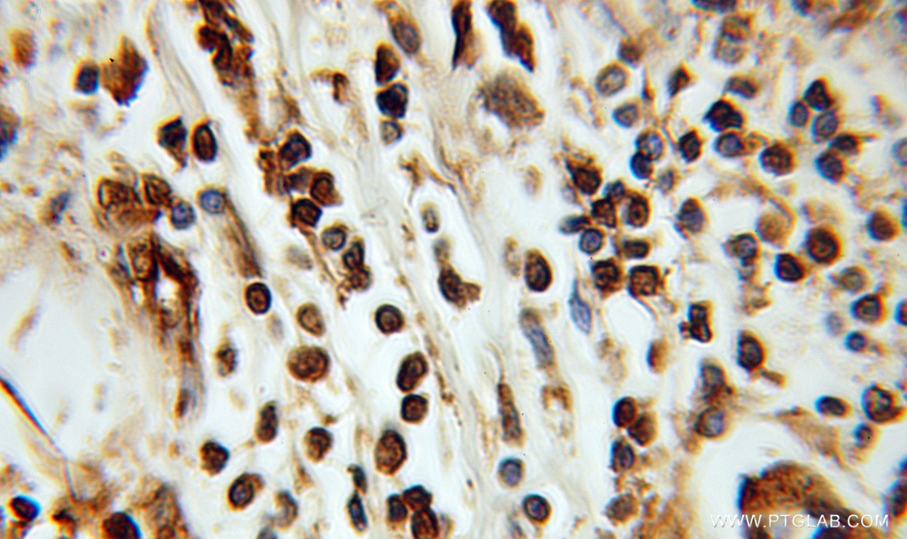 IHC staining of human breast cancer using 10905-1-AP
