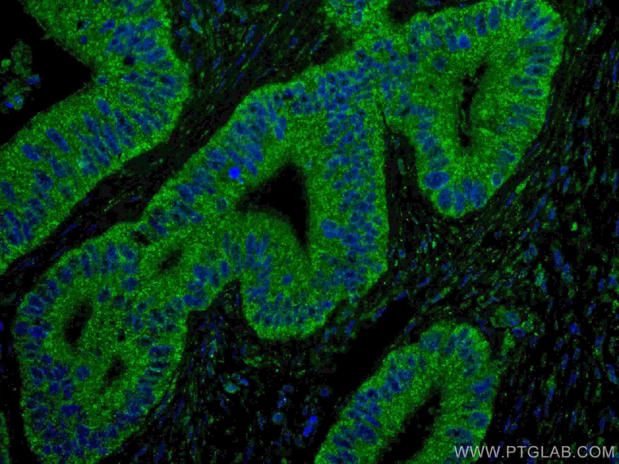 IF Staining of human colon cancer using 67754-1-Ig (same clone as 67754-1-PBS)