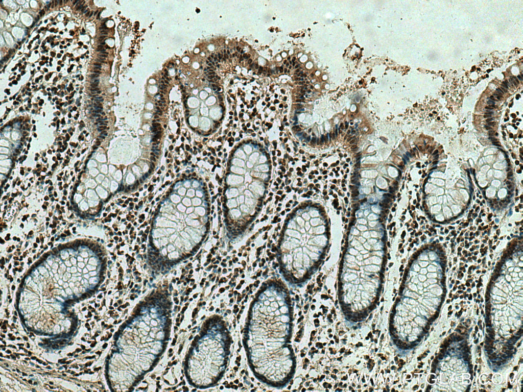 IHC staining of human colon cancer using 67754-1-Ig (same clone as 67754-1-PBS)