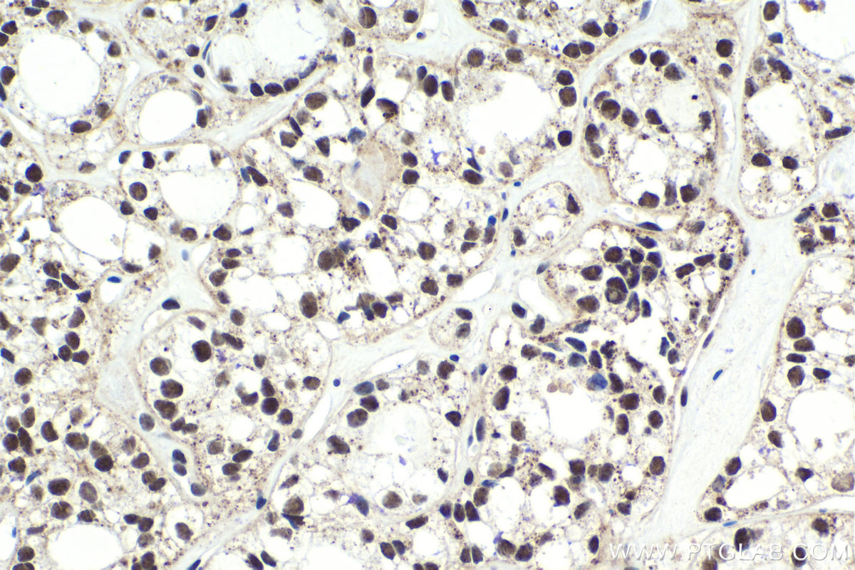 IHC staining of human thyroid cancer using 10665-1-AP (same clone as 10665-1-PBS)