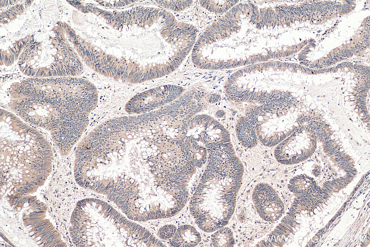 IHC staining of human colon cancer using 24819-1-AP