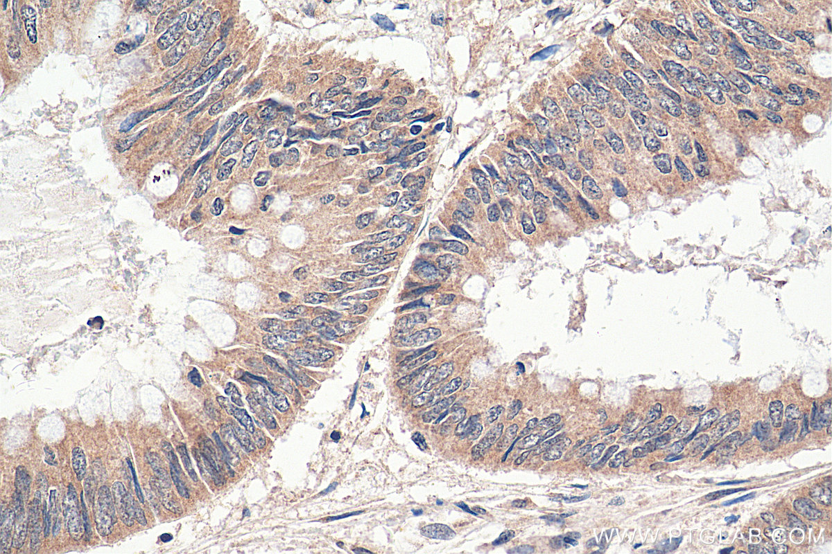 IHC staining of human colon cancer using 24819-1-AP